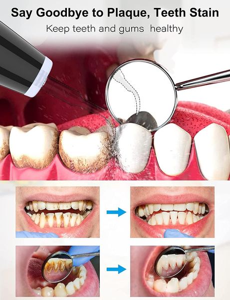 Ультразвуковий набір для чищення зубів, зубного каменю 5 режимів, 3 змінні головки 1166 фото